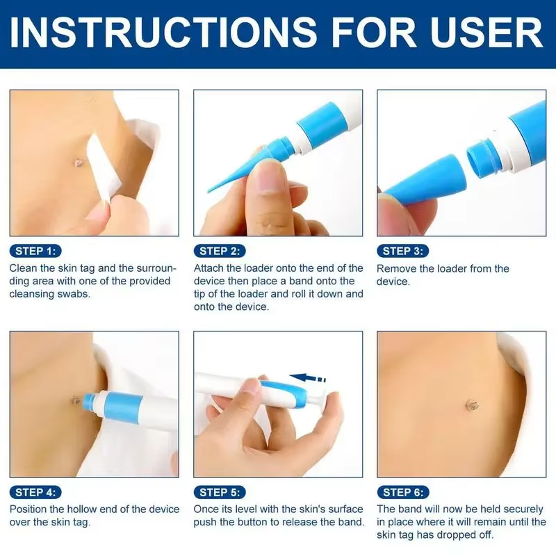 ByeTag Kit ™ – Skin Tag Removal Made Easy