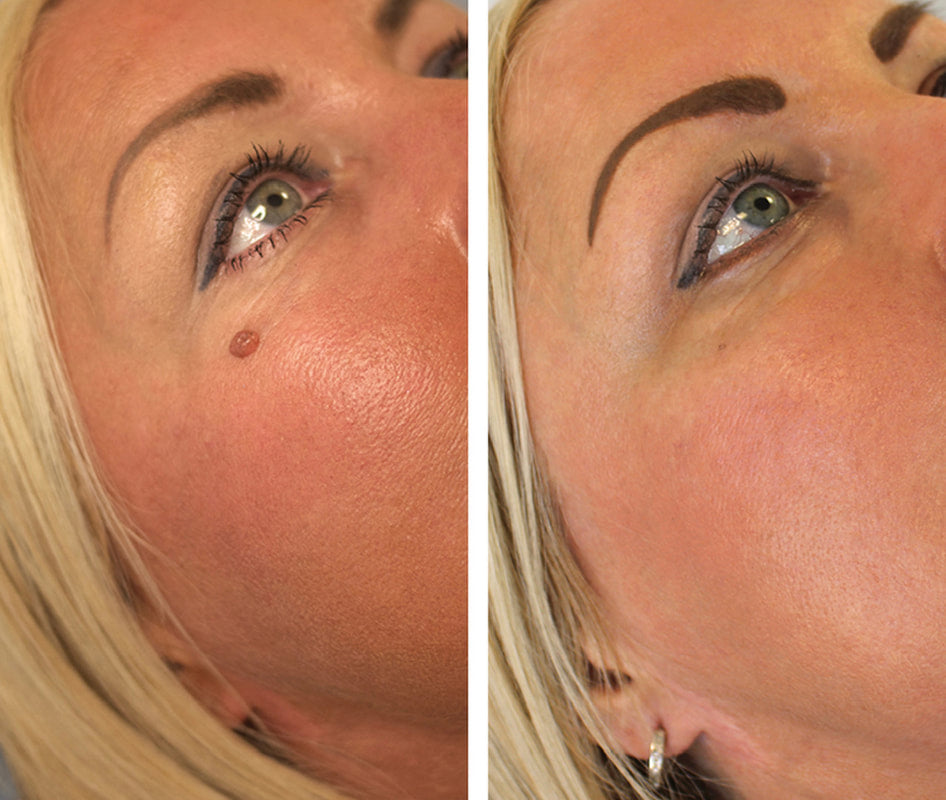 ByeTag Kit ™ – Skin Tag Removal Made Easy