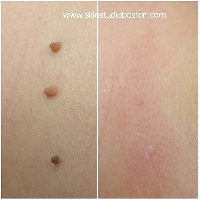 ByeTag Kit ™ – Skin Tag Removal Made Easy