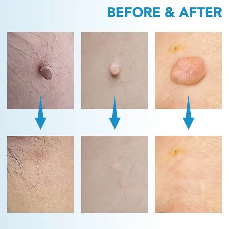 ByeTag Kit ™ – Skin Tag Removal Made Easy